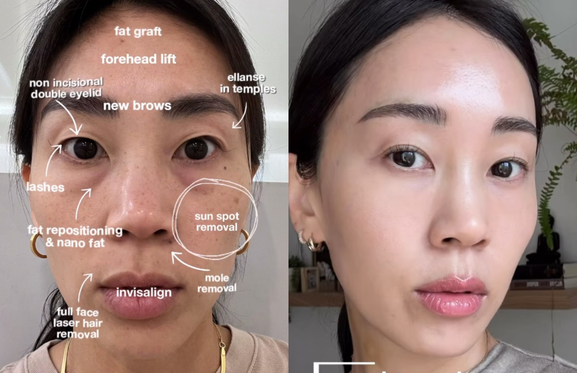 Indústria da beleza em Seul utiliza tecidos humanos em procedimentos estéticos