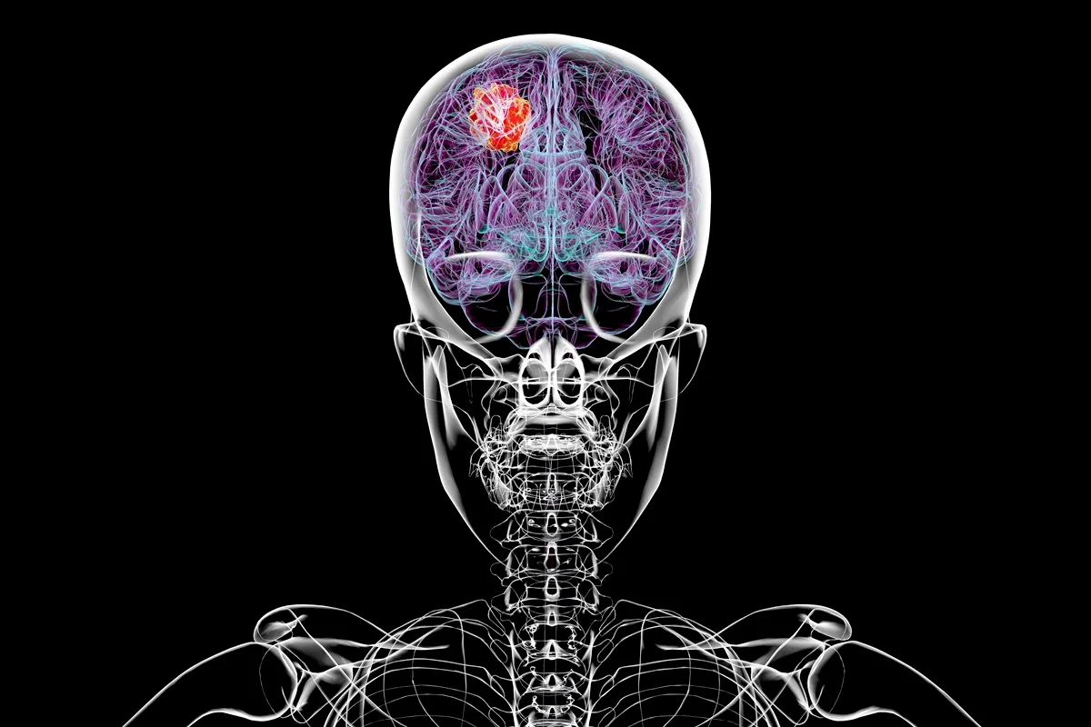Estudo liga uso de contraceptivos a maior risco de tumor cerebral