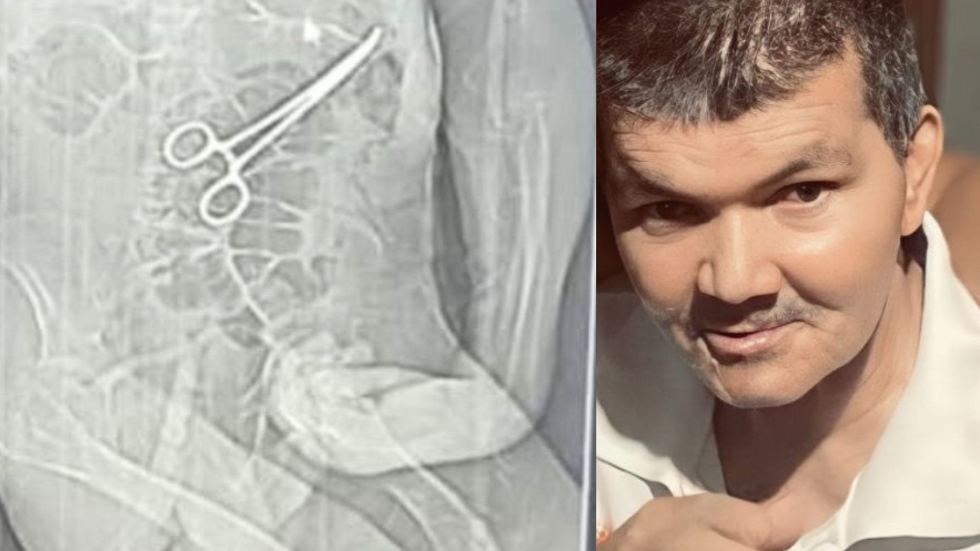 Pinça esquecida em cirurgia: médicos indiciados por morte de paciente em João Pinheiro, MG