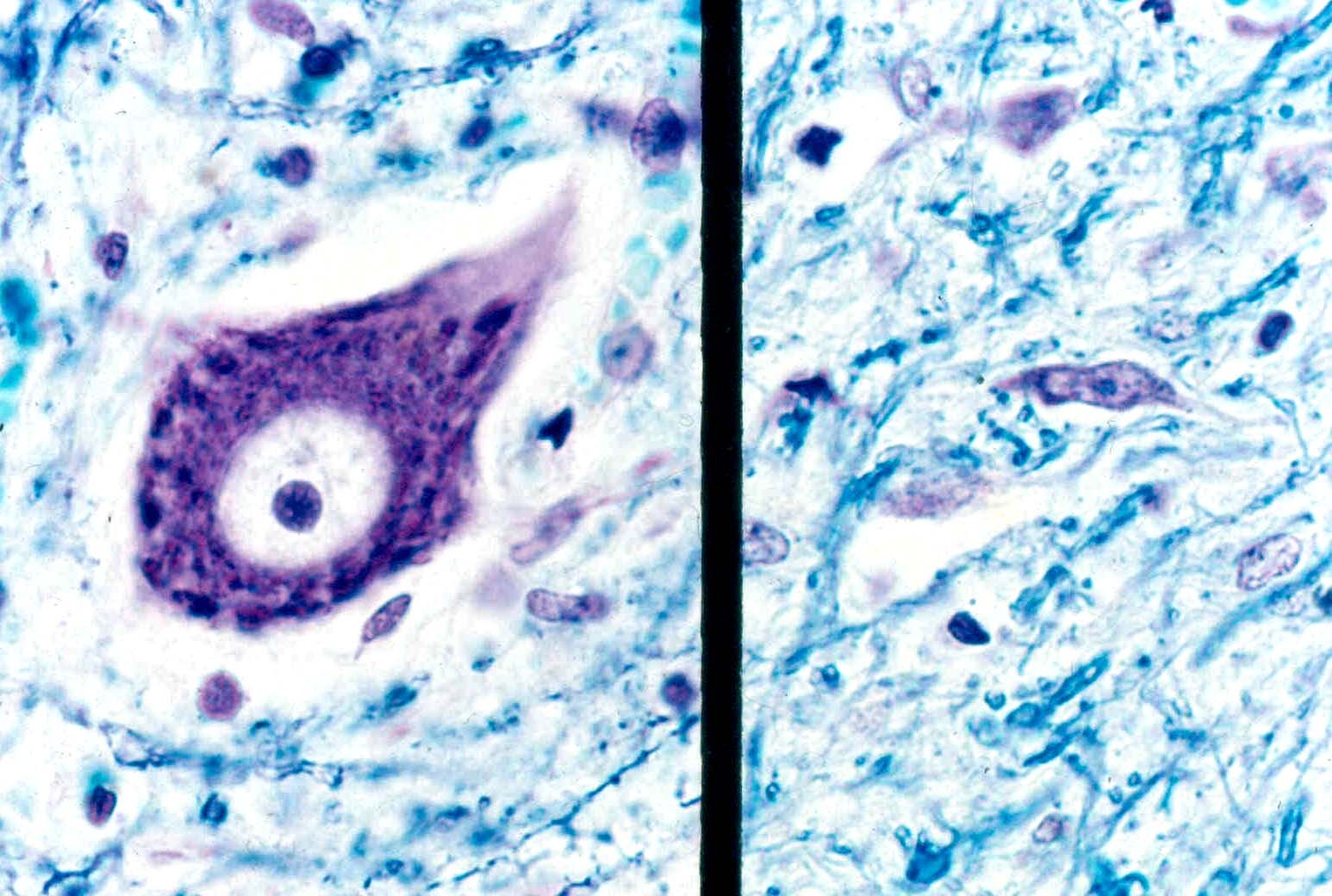 Painel de proteínas sanguíneas antecipa diagnóstico da ELA