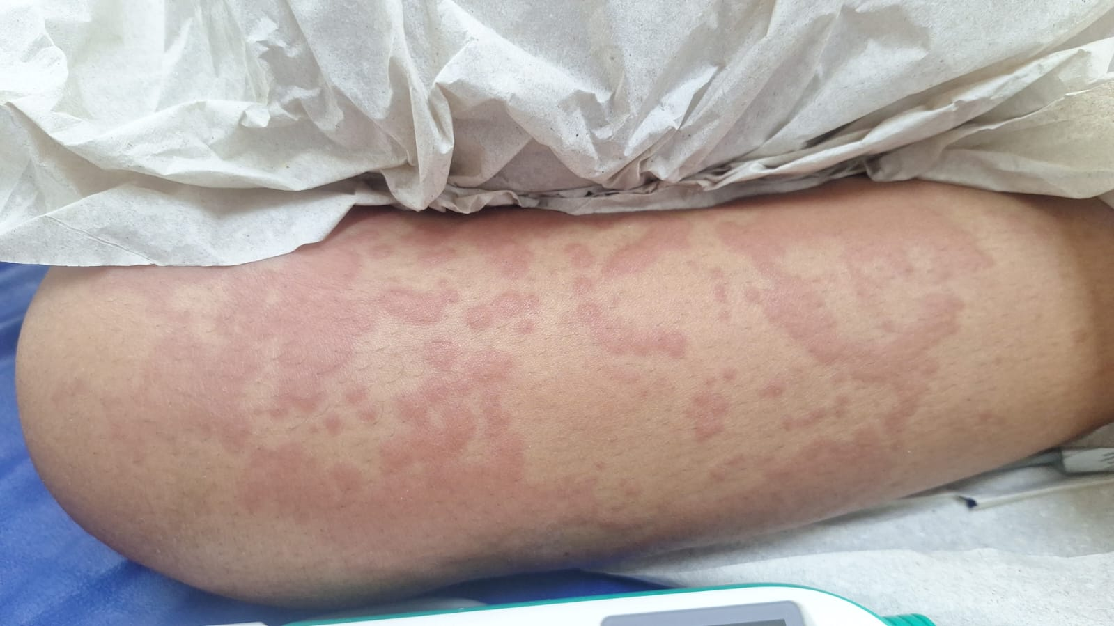 Sesap descarta contaminação por detergente em criança internada por infecção