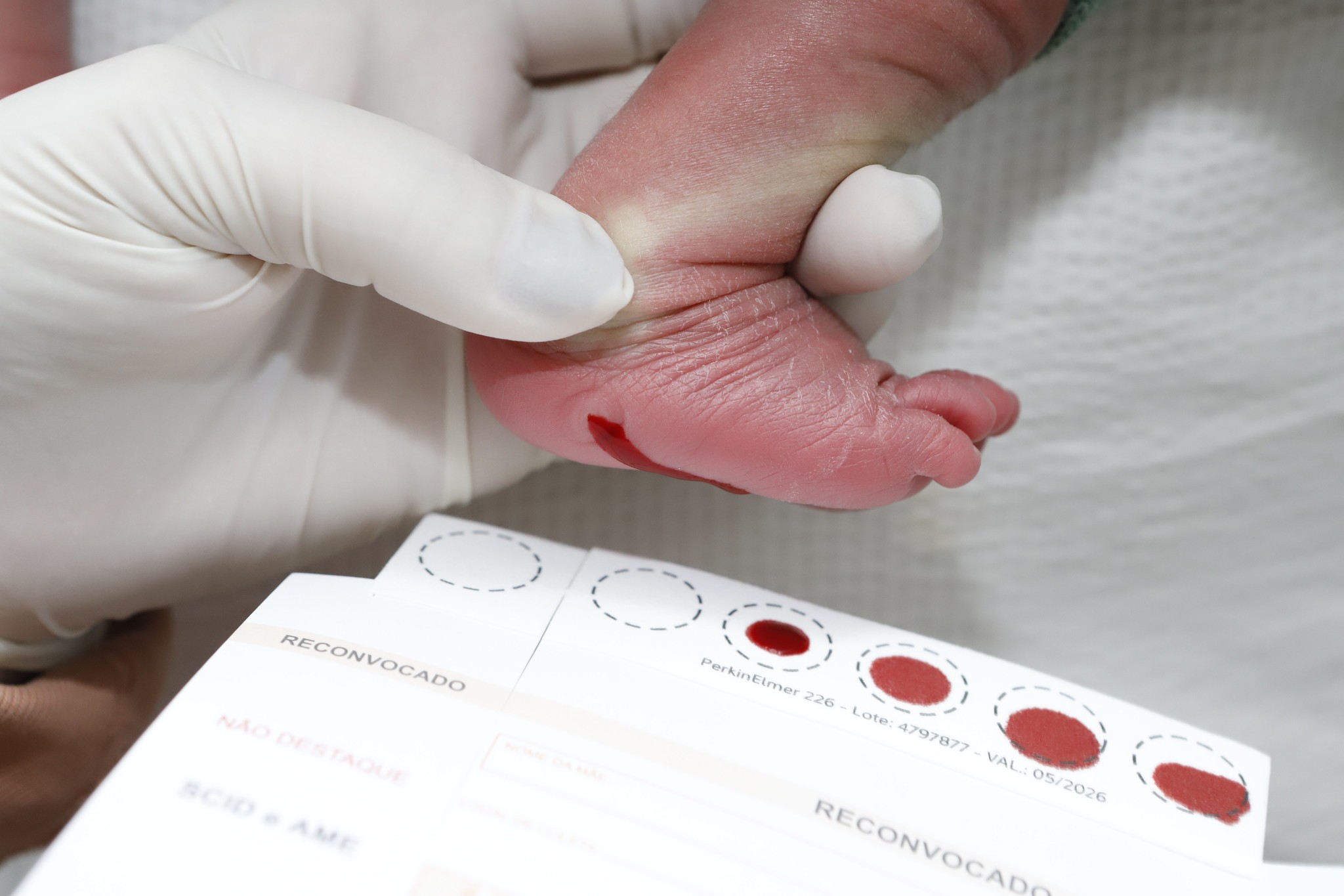 Distrito Federal é referência nacional em triagem neonatal e diagnostica 62 doenças pelo teste do pezinho