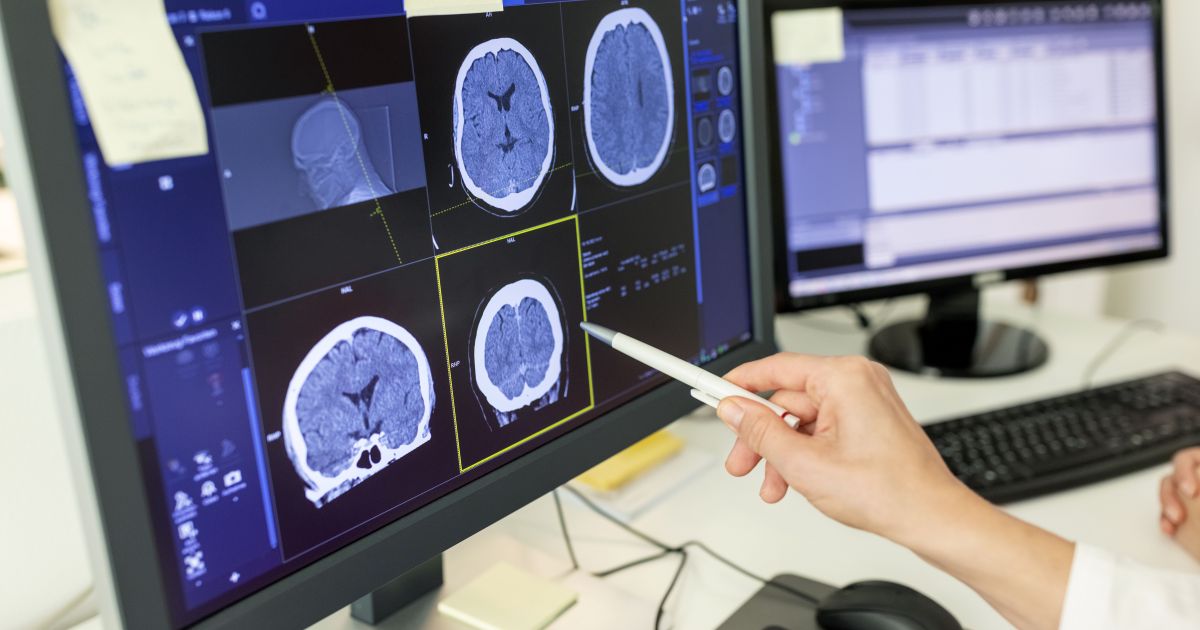 USP revoluciona tratamento de Alzheimer e Parkinson