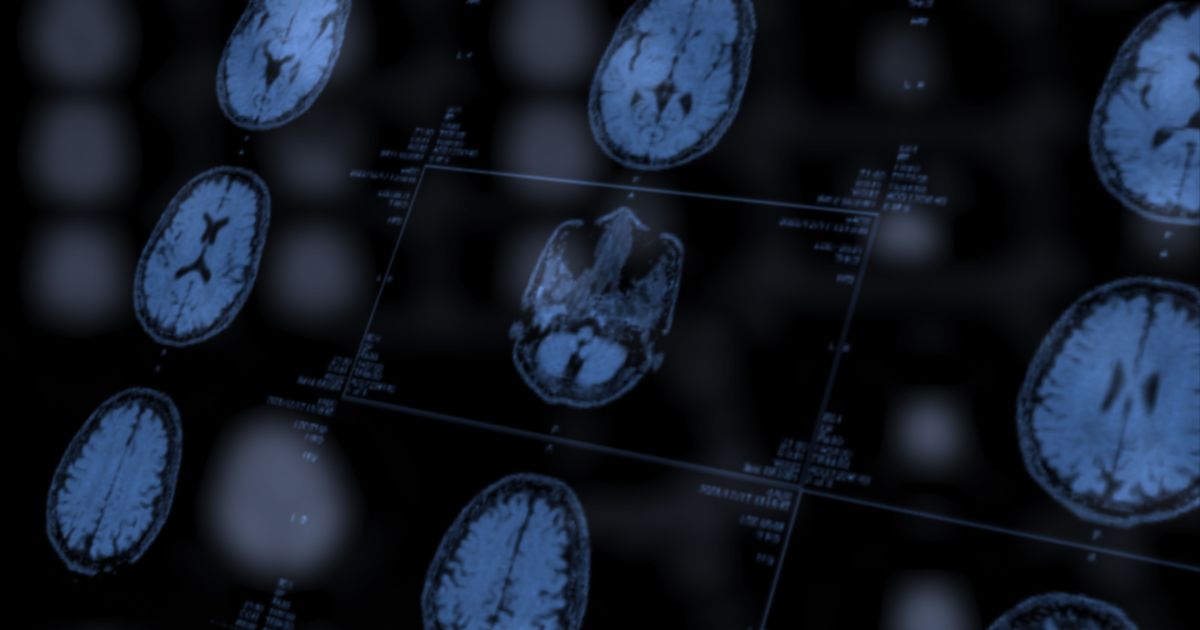 Vacina personalizada anima pesquisa sobre glioblastoma, diz Washington