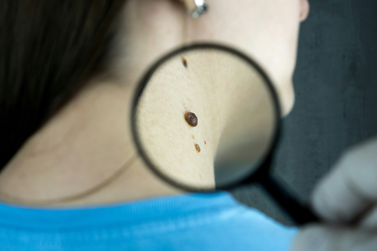 Profissionais da beleza em Natal capacitados para identificar sinais de melanoma